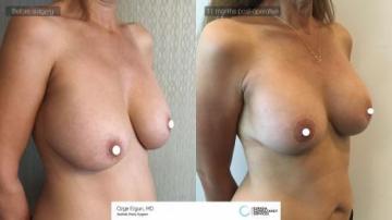 Breast_Lift_implant_change_1_2