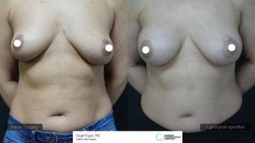 ba_af_emsn_breast_implant1