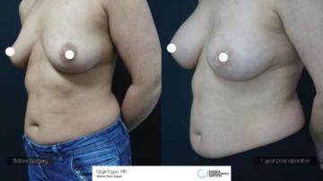 ba_af_emsn_breast_implant2