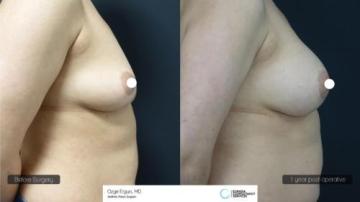 ba_af_emsn_breast_implant4