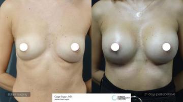 ba_af_sbr_breast_augmentation1