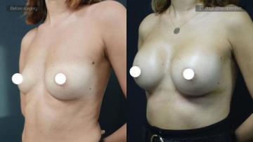 ba_af_sbr_breast_augmentation2