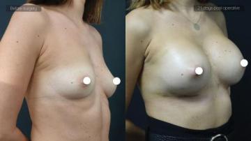 ba_af_sbr_breast_augmentation3