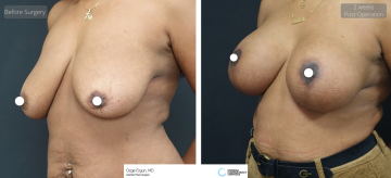 be_af_ardg_breast_surgery_2