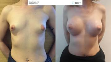 be_af_sk_breastimplant_1