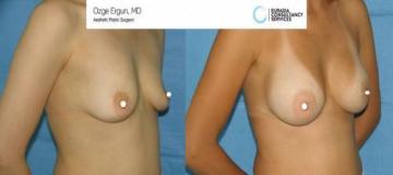 breast_implant_OE_1_2