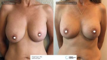 Breast_Lift_implant_change_1_1
