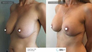 Breast_Lift_implant_change_1_3_
