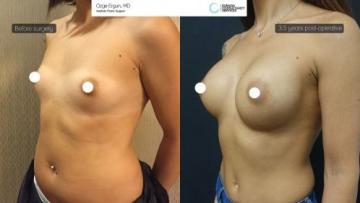 ba_af_dast_breast_augmentation3