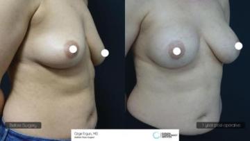ba_af_emsn_breast_implant3