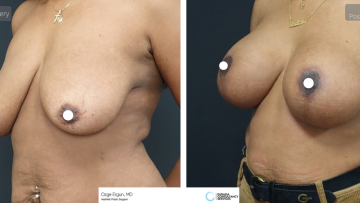 be_af_ardg_breast_surgery_2
