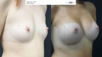 be_af_do_breastimplant_1