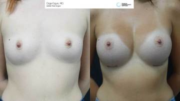 be_af_do_breastimplant_2