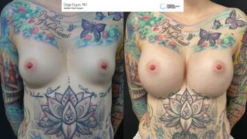be_af_jig_breastimplant_1