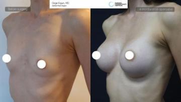 breast-implant-01