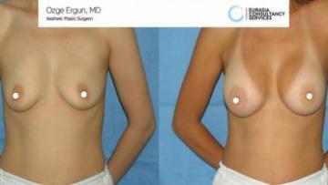 breast_implant_OE_1_1