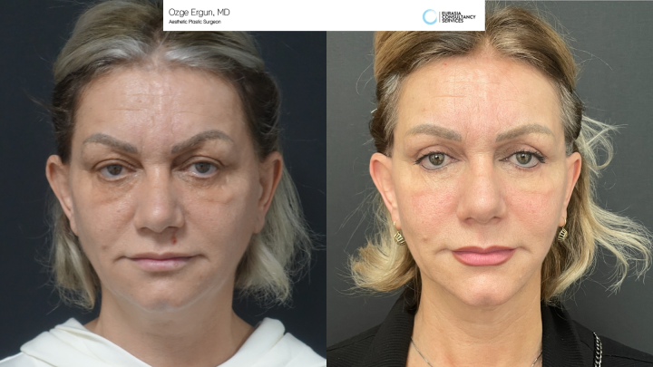 Face / Neck Lift - Plastic Surgery Before and After Photos