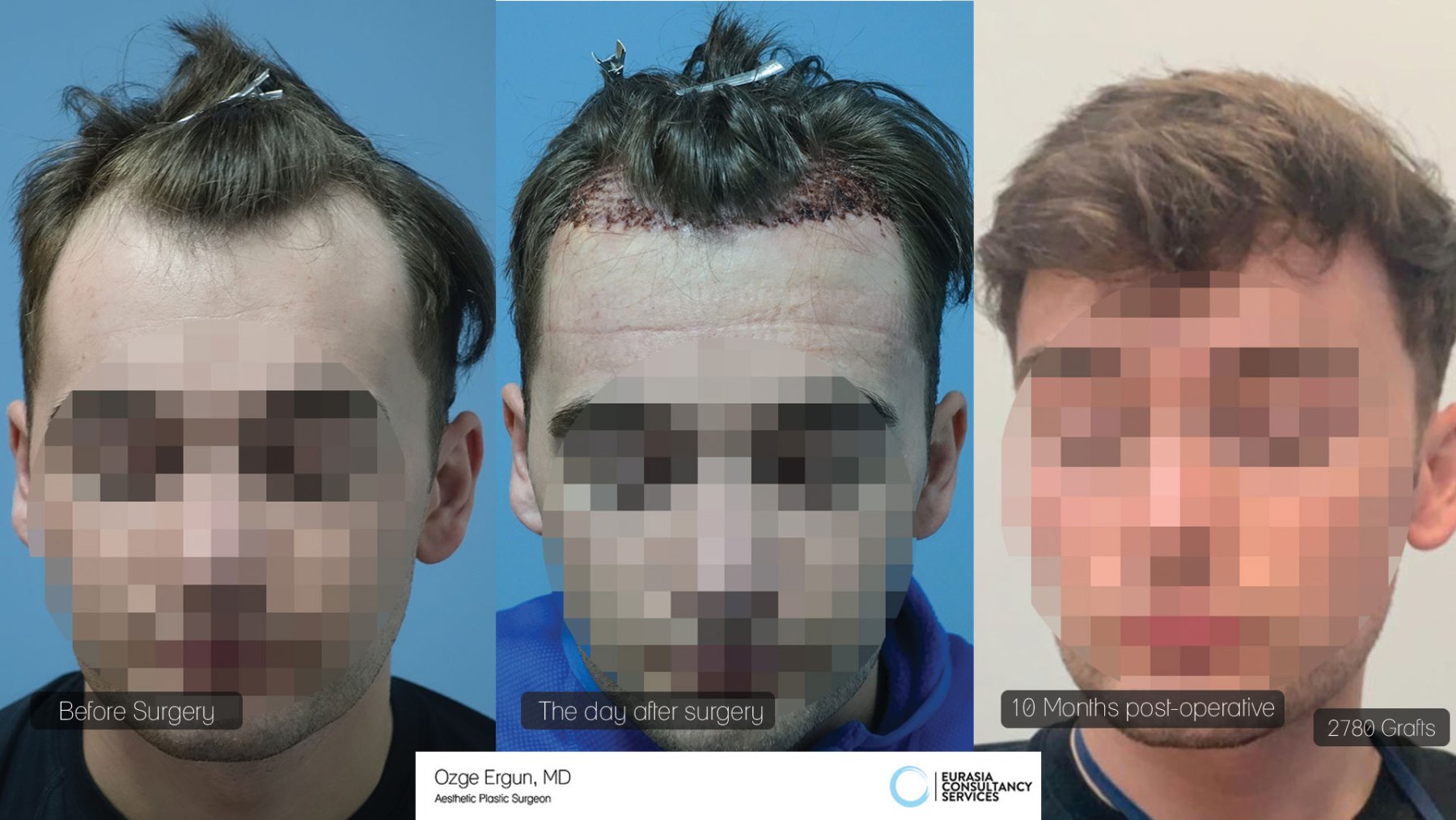 Hair Transplant - Plastic Surgery Before And After Photos